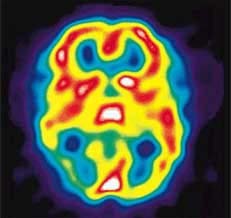 migraine brain photo